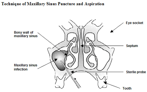 ANTRAL PUNCTURE
