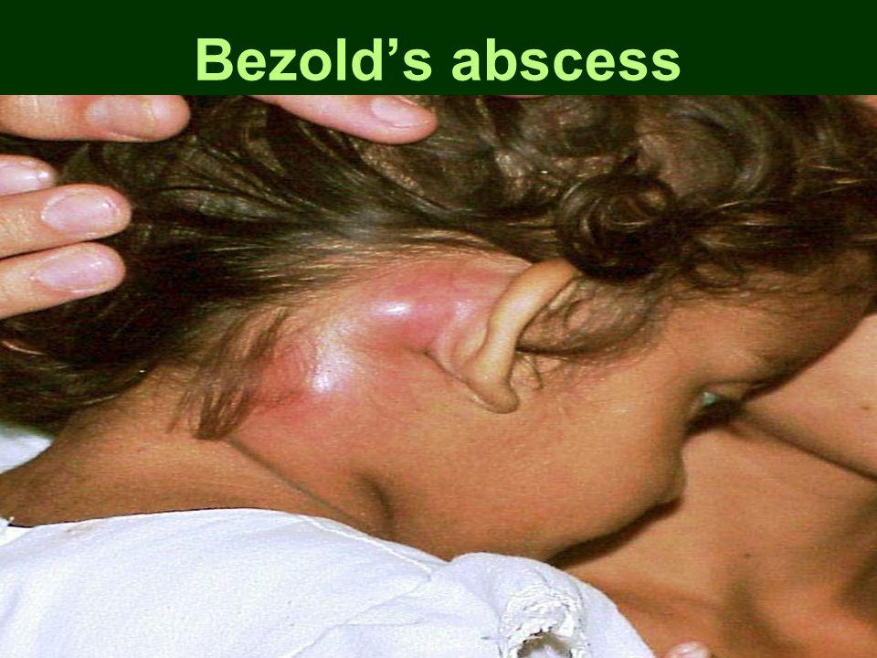 Bezold’s abscess