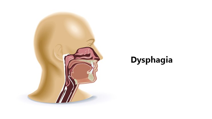 CAUSES OF DYSPHAGIA