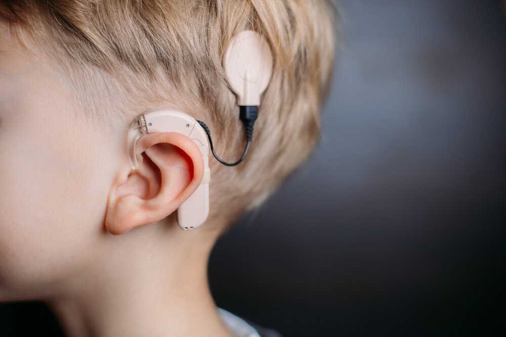 cochlear implant