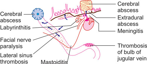 chronic suppurative otitis media