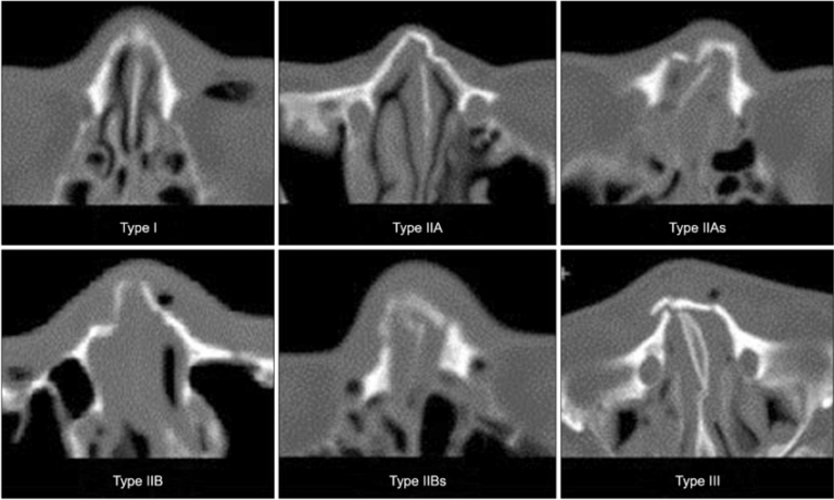 nose - NASAL BONE FRACTURE - Dr Meenesh Juvekar - ENT Specialist