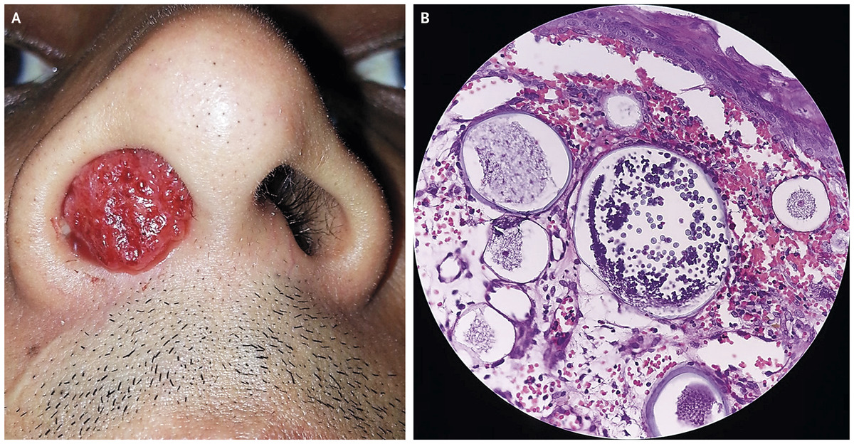 ENT Specialist Doctor In Mumbai nose - RHINOSPORIDIOSIS RHINOSPORIDIOSIS