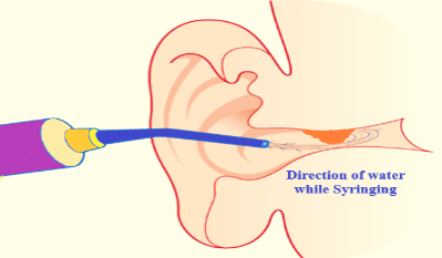 What to Expect During an Ear Irrigation Procedure