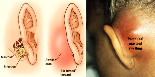 mastoiditis pathophysiology