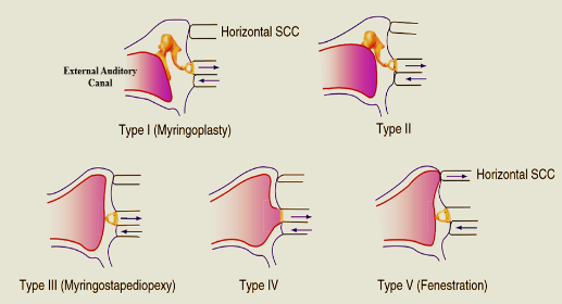 Classification of Tympanoplasty