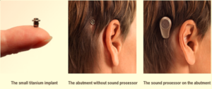 Ear - HEARING AIDS - Dr. Meenesh Juvekar - ENT Specialist