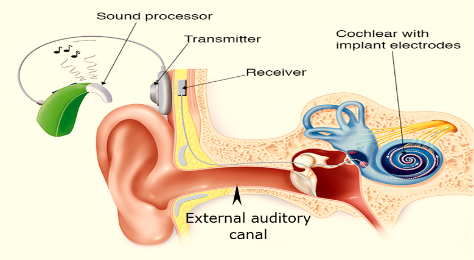 cochlear implants internal ear