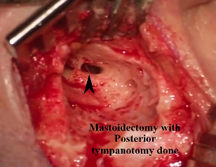 Mastoidectomy