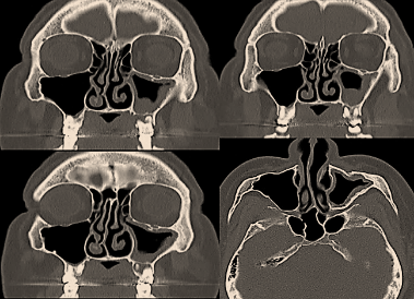 ENT Specialist Doctor In Mumbai Screenshot 2020 11 27 Ganpati nose