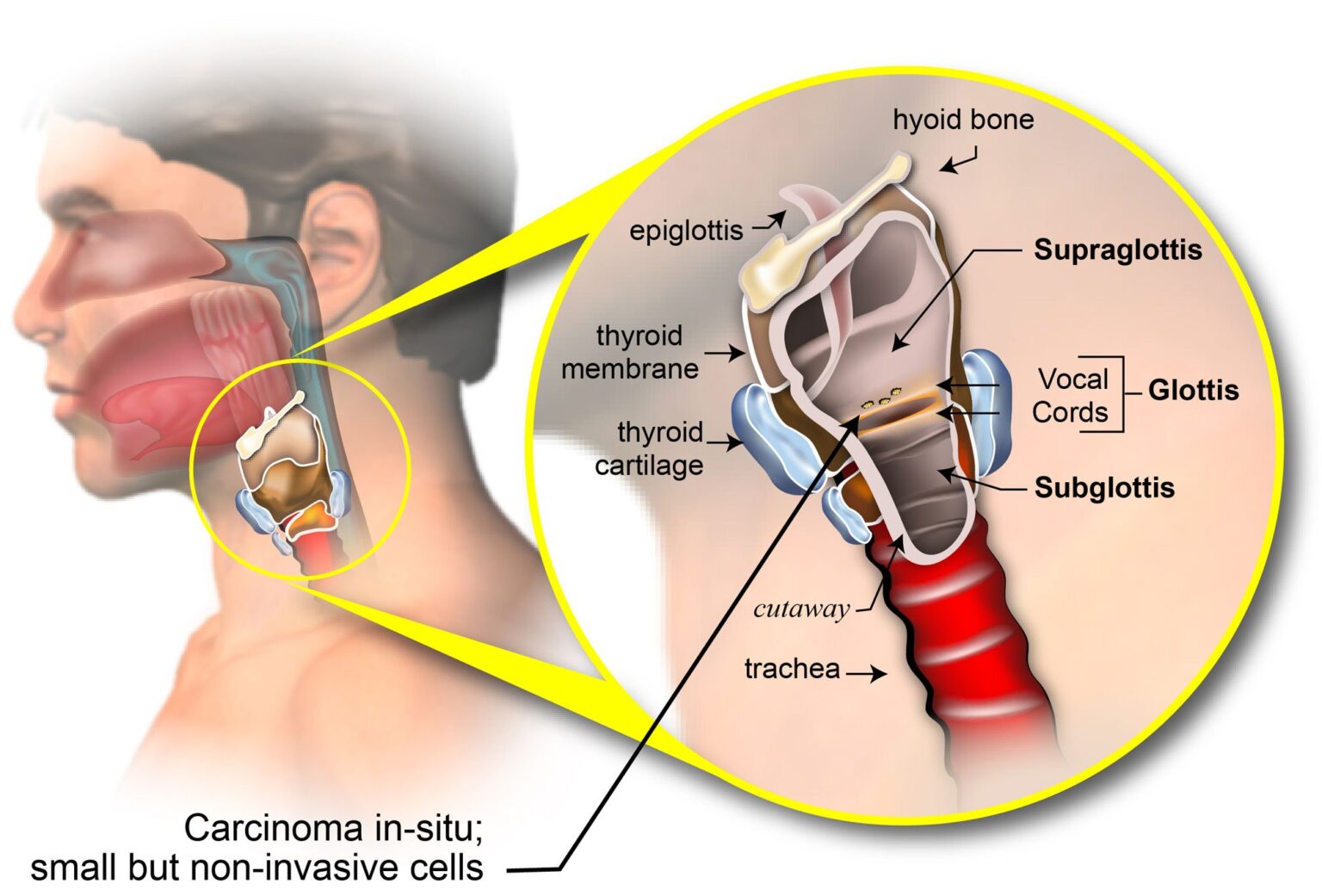 Larynx Carcinoma Of Larynx Dr Meenesh Juvekar Ent Specialist