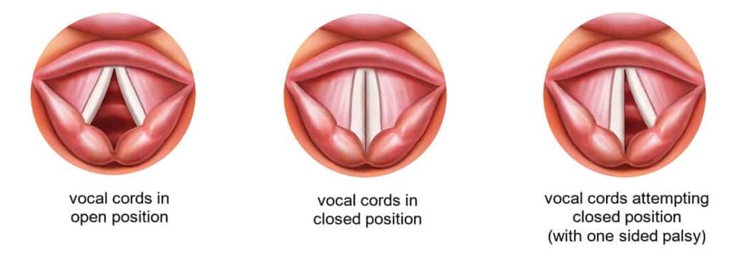 larynx-causes-of-vocal-cord-palsy-dr-meenesh-juvekar-ent-specialist