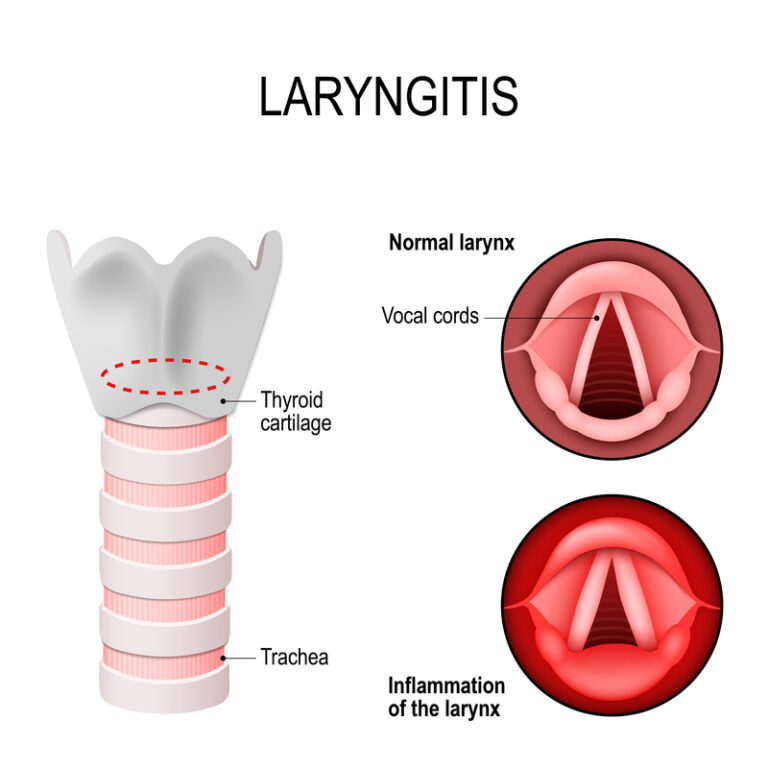 Larynx - CHRONIC LARYNGITIS - Dr. Meenesh Juvekar - ENT Specialist