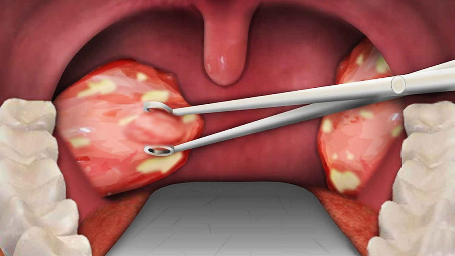 INDICATIONS AND CONTRAINDICATIONS OF TONSILLECTOMY