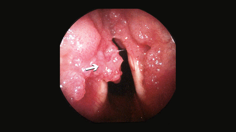 Removal of laryngeal papilloma - Removal of laryngeal papilloma