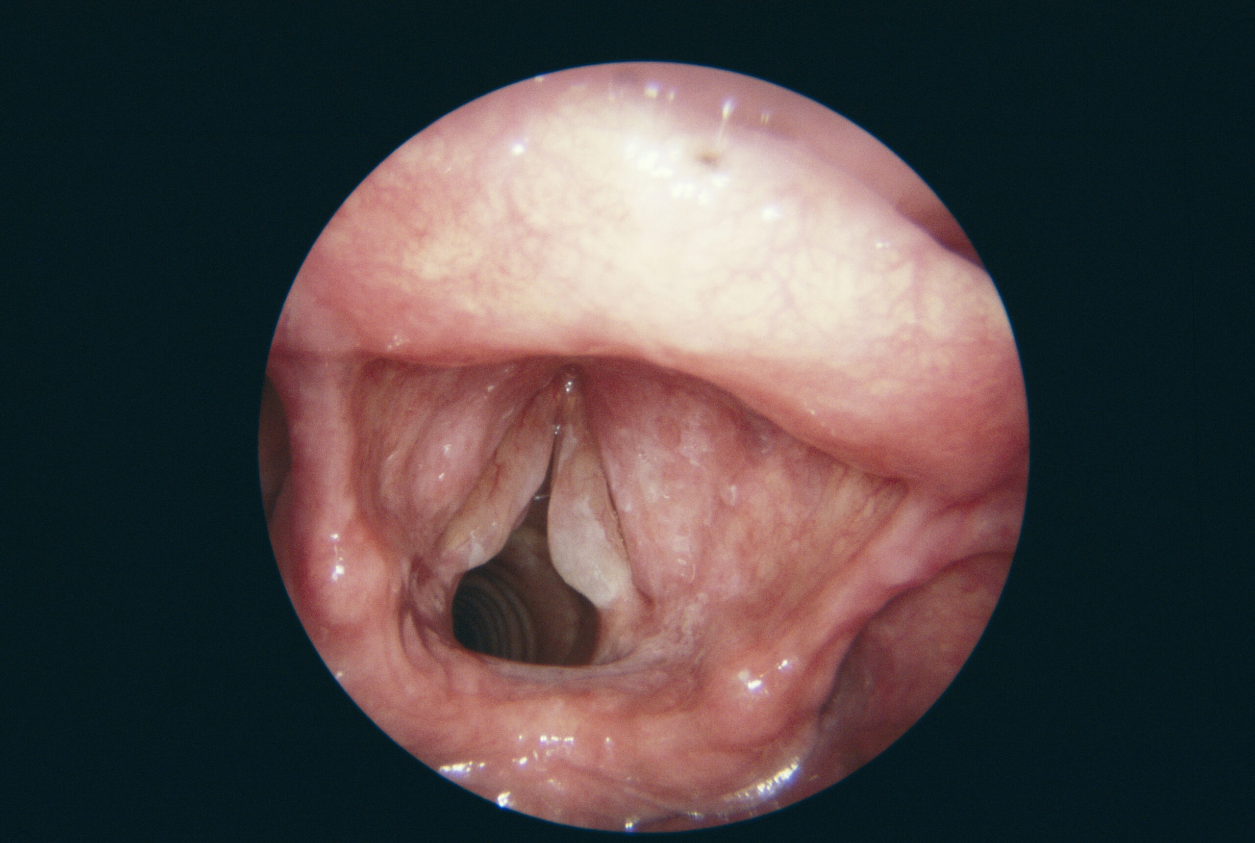 ENT Specialist Doctor In Mumbai LARYNGEAL OEDEMA scaled