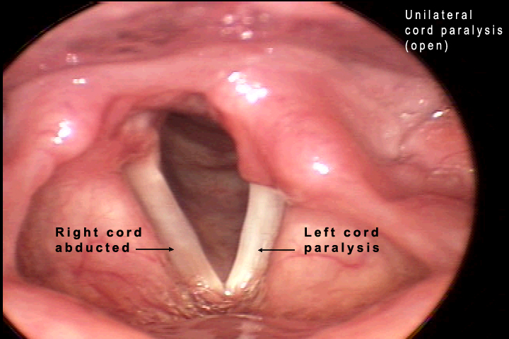 LEFT VOCAL CORD PALSY