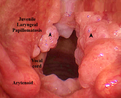 most common site of laryngeal papillomatosis