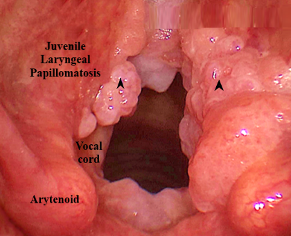 laryngeal papilloma)