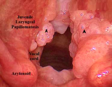 ENT Specialist Doctor In Mumbai Screenshot 2020 12 01 larynx 2020 new bs almost final edted 8 9 2020 2