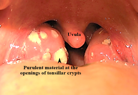Sex oral tonsillitis from Tonsils and