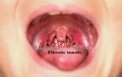 From sex tonsillitis oral Tonsillitis after