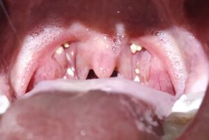 keratosis tonsillar ent pharyngis tonsils